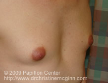 Breast Augmentation Pre-Op